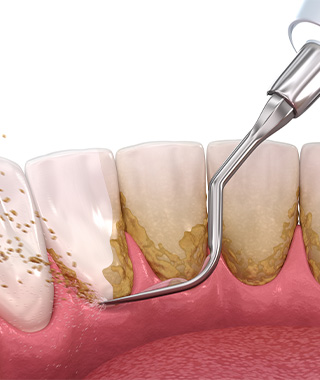 スケーリング（歯石除去）